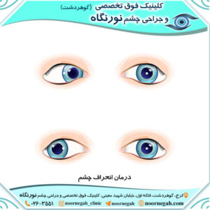 درمان انحراف چشم